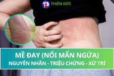 MỀ ĐAY (NỔI MẨN NGỨA): NGUYÊN NHÂN, TRIỆU CHỨNG VÀ CÁCH XỬ TRÍ