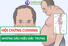 HỘI CHỨNG CUSHING: NHỮNG DẤU HIỆU ĐẶC TRƯNG