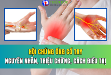 HỘI CHỨNG ỐNG CỔ TAY: NGUYÊN NHÂN, TRIỆU CHỨNG VÀ CÁC PHƯƠNG PHÁP ĐIỀU TRỊ