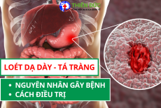 LOÉT DẠ DÀY TÁ TRÀNG: NGUYÊN NHÂN, CÁC YẾU TỐ NGUY CƠ, CÁCH ĐIỀU TRỊ VÀ PHÒNG NGỪA TÁI PHÁT