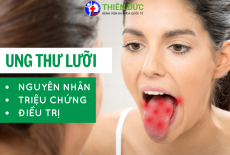 UNG THƯ LƯỠI: NGUYÊN NHÂN, TRIỆU CHỨNG VÀ PHƯƠNG PHÁP ĐIỀU TRỊ