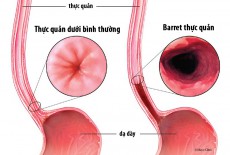 TRÀO NGƯỢC DẠ DÀY -  BARRETT THƯC QUẢN