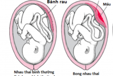 RAU BONG NON - CẤP CỨU SẢN KHOA NGUY HIỂM