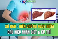 NHỮNG BIẾN CHỨNG CỦA XƠ GAN: DẤU HIỆU NHẬN BIẾT VÀ CÁCH XỬ TRÍ
