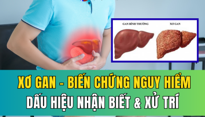 NHỮNG BIẾN CHỨNG CỦA XƠ GAN: DẤU HIỆU NHẬN BIẾT VÀ CÁCH XỬ TRÍ