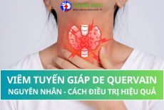 VIÊM TUYẾN GIÁP DE QQUERVAIN: NGUYÊN NHÂN VÀ CÁCH ĐIỀU TRỊ HIỆU QUẢ