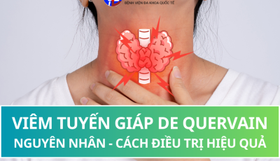 VIÊM TUYẾN GIÁP DE QQUERVAIN: NGUYÊN NHÂN VÀ CÁCH ĐIỀU TRỊ HIỆU QUẢ