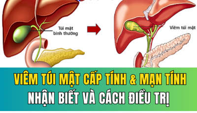 VIÊM TÚI MẬT CẤP TÍNH VÀ MẠN TÍNH: DẤU HIỆU NHẬN BIẾT VÀ CÁCH ĐIỀU TRỊ