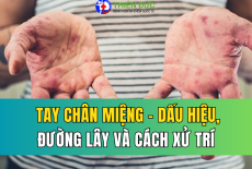 TAY CHÂN MIỆNG: DẤU HIỆU NHẬN BIẾT SỚM Ở TRẺ, ĐƯỜNG LÂY VÀ CÁCH XỬ TRÍ