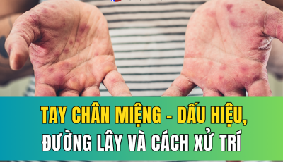 TAY CHÂN MIỆNG: DẤU HIỆU NHẬN BIẾT SỚM Ở TRẺ, ĐƯỜNG LÂY VÀ CÁCH XỬ TRÍ