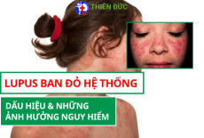 LUPUS BAN ĐỎ HỆ THỐNG: DẤU HIỆU VÀ NHỮNG ẢNH HƯỞNG NGUY HIỂM