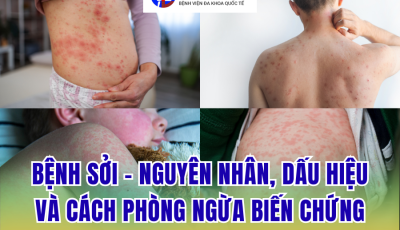BỆNH SỞI: NGUYÊN NHÂN, DẤU HIỆU NHẬN BIẾT SỚM VÀ CÁCH PHÒNG NGỪA BIẾN CHỨNG