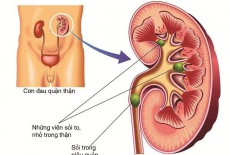 NHỮNG BIẾN CHỨNG SỎI NIỆU QUẢN GÂY RA