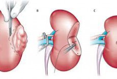 PHÁT HIỆN VÀ ĐIỀU TRỊ THÀNH CÔNG U CƠ MỠ MẠCH THẬN TẠI BV ĐKQT THIÊN ĐỨC