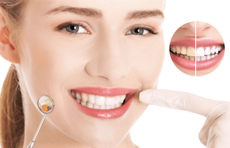 Lấy cao răng có tác dụng kéo dài không?
