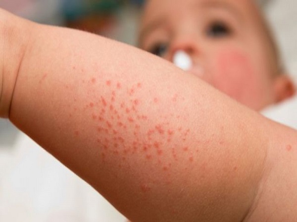 sốt virus: Bệnh ở trẻ nhỏ thường gặp